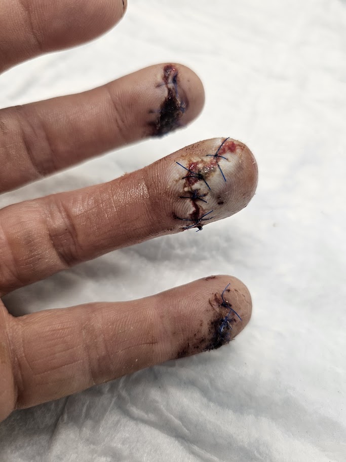 Three fingers, palm side, with obvious fresh stitches